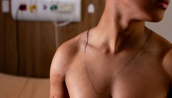 O-adolescente-Eduardo-Linhares-17-anos-mostra-as-queimaduras-sofridas-por-queda-de-raio-durante-a-ma