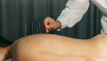 acupunturaacupuncture-process_-2