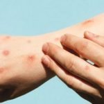 Ilustração de vírus da Mpox com destaque em lesões cutâneas e sintomas associado