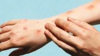 Ilustração de vírus da Mpox com destaque em lesões cutâneas e sintomas associado