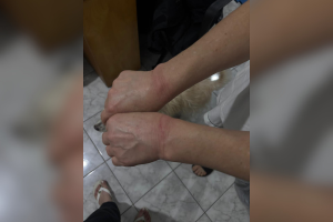 Foto: 1 de 1 Imagem colorida de marcas de lesão em punhos. Metrópoles - Foto: Di