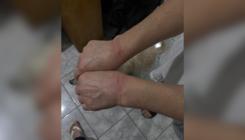 Foto: 1 de 1 Imagem colorida de marcas de lesão em punhos. Metrópoles - Foto: Di
