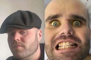 Imagem colorida mostra homem branco com os olhos amarelados — Foto: 1 de 1 Image