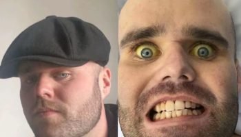 Imagem colorida mostra homem branco com os olhos amarelados — Foto: 1 de 1 Image