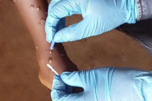 Representação do vírus que causa a mpox, família da varíola, e lesões cutâneas t