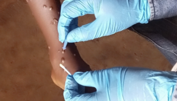 Representação do vírus que causa a mpox, família da varíola, e lesões cutâneas t