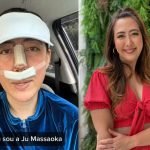 PMMA no rosto: saiba como identificar material após rinoplastia — Foto: 1 de 1 P