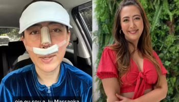 PMMA no rosto: saiba como identificar material após rinoplastia — Foto: 1 de 1 P