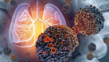 pulmao-cancer-de-pulmao